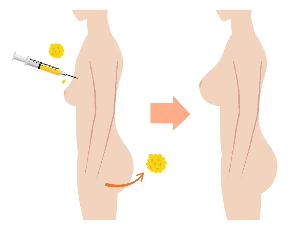 脂肪注入豊胸の説明イラスト