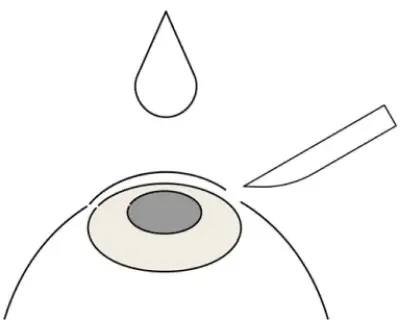 網膜の際を切開